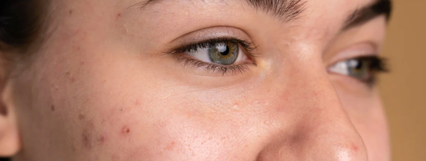 Gros plan sur le visage d'une femme présentant des imperfections cutanées, mettant en évidence son acné.