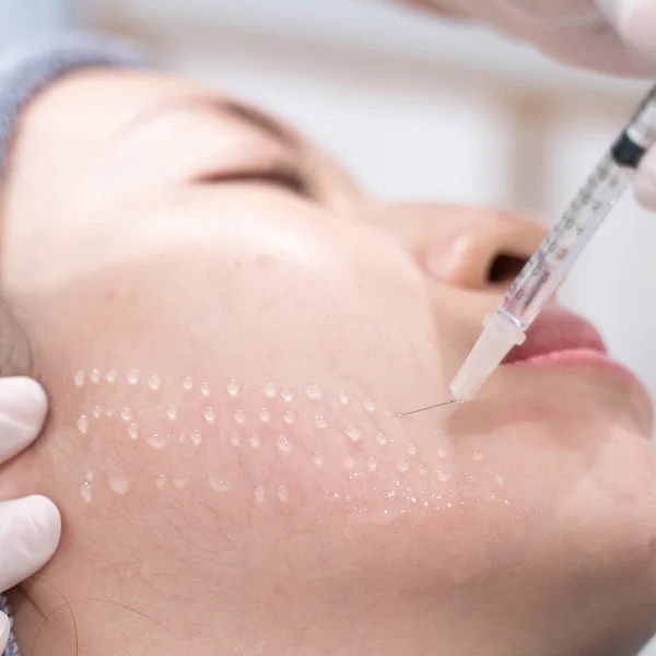 Une femme reçoit un traitement facial avec une aiguille pour l'injection d'acide hyaluronique.