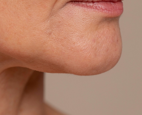 Une femme avec un petit cou, réfléchissant à une injection pour le double menton.